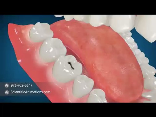 root-canal-treatment_640x48